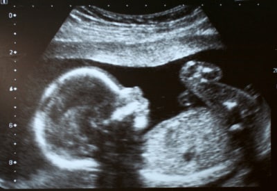 Ultrasound 2D image using 85 db pulses.